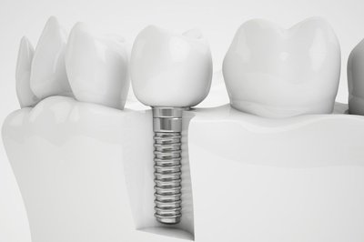 �Qu� son los implantes dentales?