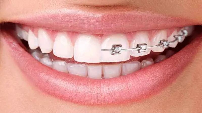 invisalign o brackets